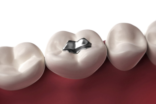 amalgam fillings