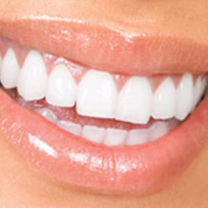 teeth whitening